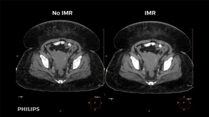 Iterative Model Reconstruction | Philips
