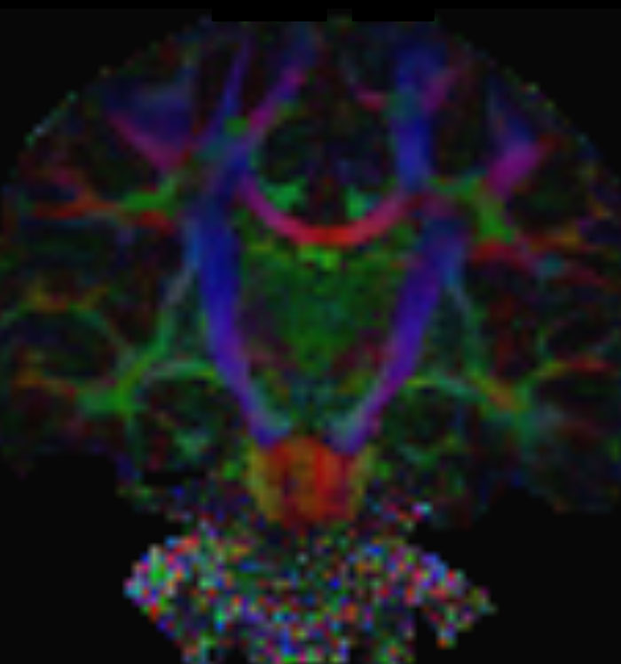 MultiBand SENSE diffusion color FA