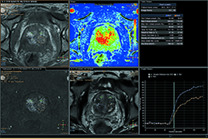 image for mr t1 perfusion