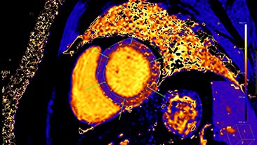 mr cardiac quantitave mapping